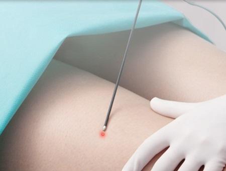 is melanotan 2 legal anywhere Melanotan  What It Is and Its Relation to Skin Cancer
